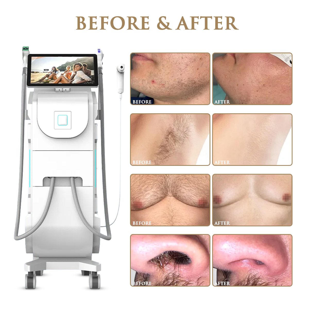 Skin Monarch Quantum Pro laser — in use